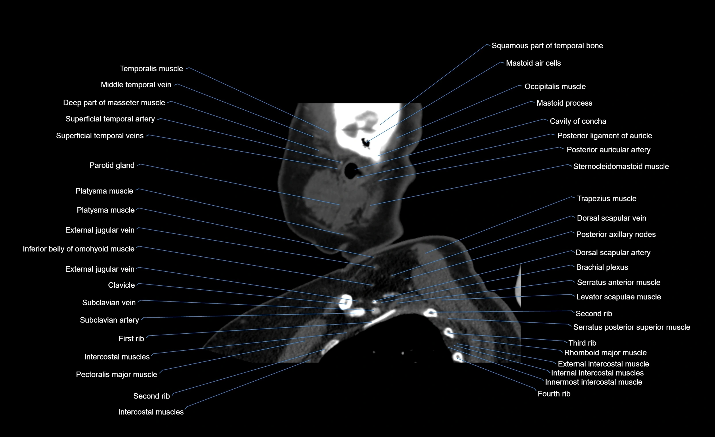 Neck CT sagittal cross sectional anatomy 3D  radiology  image-img-00001-00023.webp